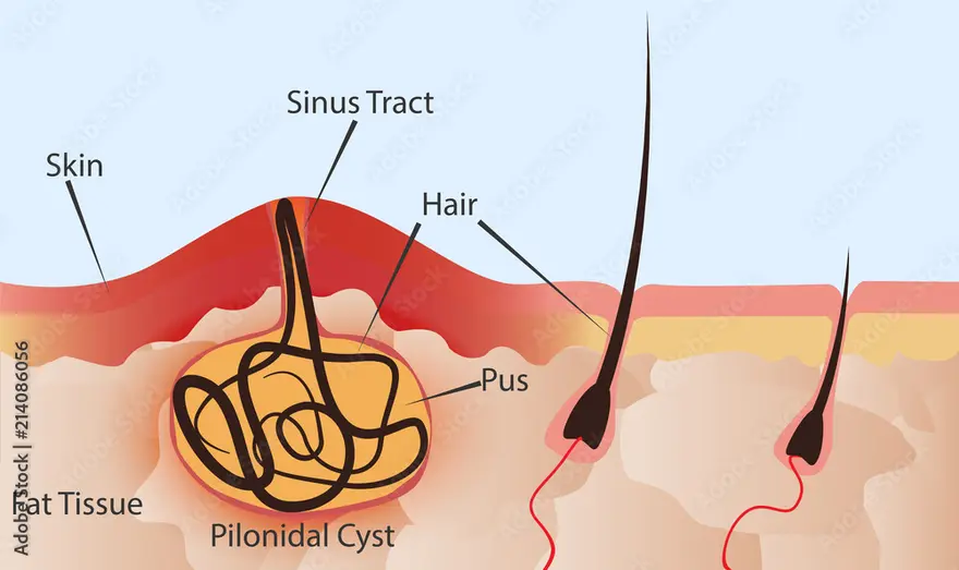 Exploring Pilonidal Sinus: Symptoms, Causes, and Treatment