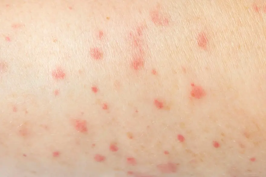 Pimple on Penis: Causes, Symptoms, and When to See a Doctor