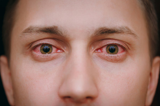 Understanding Conjunctivitis Symptoms and Signs : A Comprehensive Guide