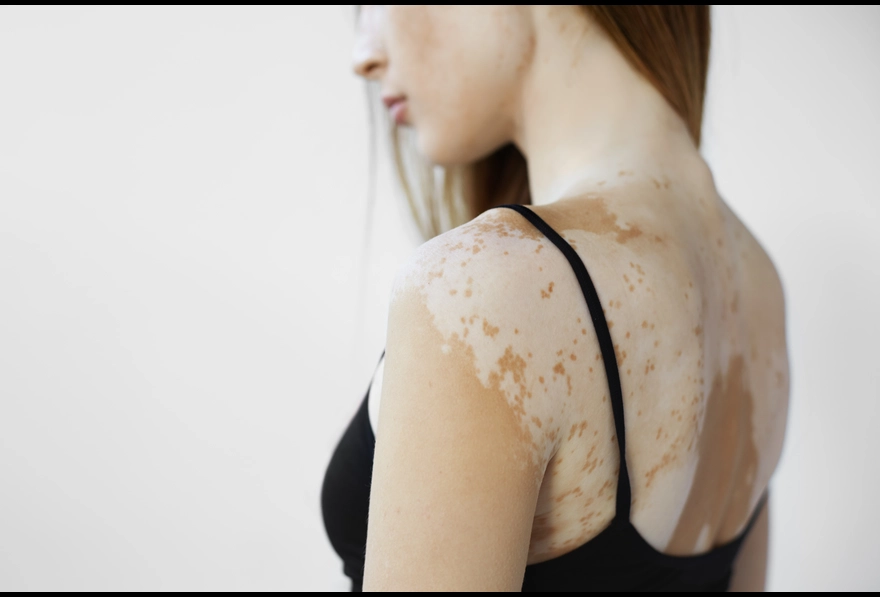Pityriasis Alba: Causes, Symptoms, and Treatment Options