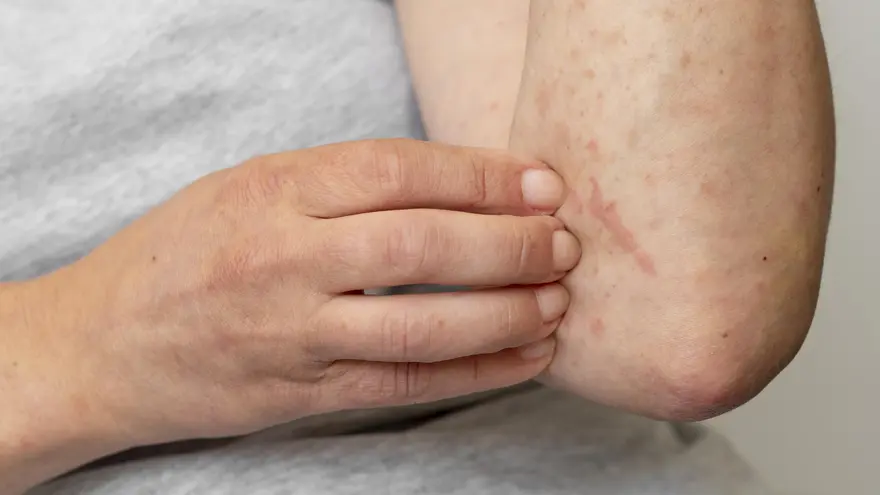 Porphyria: What You Need to Know About This Rare Blood Disorder