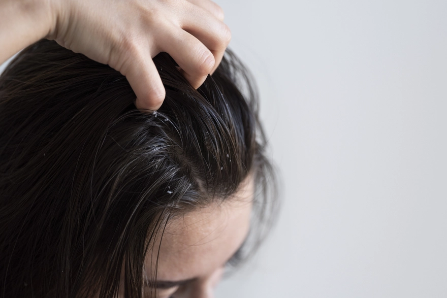 Seborrheic Dermatitis " Types, Causes, Symptoms, and Treatment