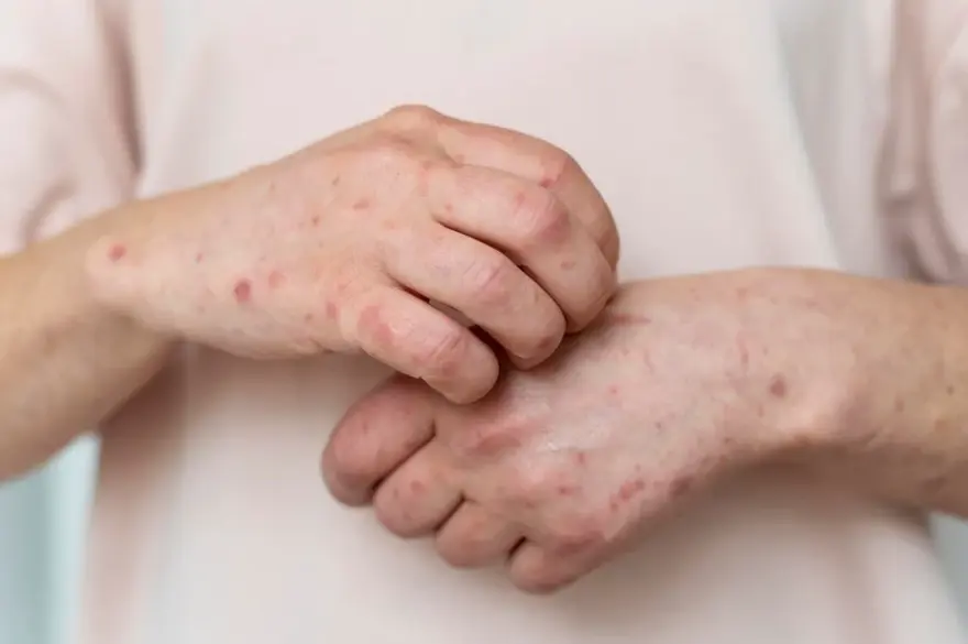Septicemia: Recognizing the Signs of Blood Poisoning and Seeking Prompt Treatment