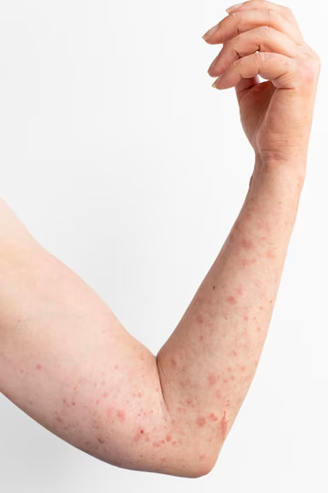 Psoriasis: Treatment, Symptoms, Causes & Types