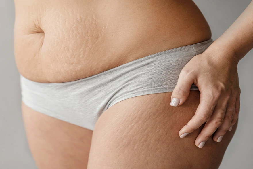 What Are Stretch Marks? Causes, Types, and How to Manage Them