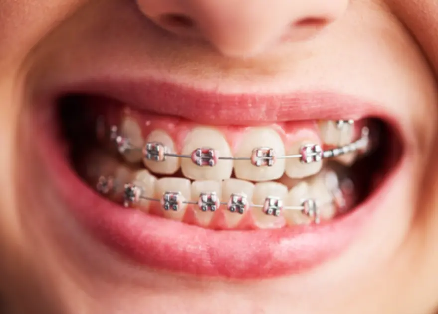 What Do Braces Mean? Definition & Medical Facts