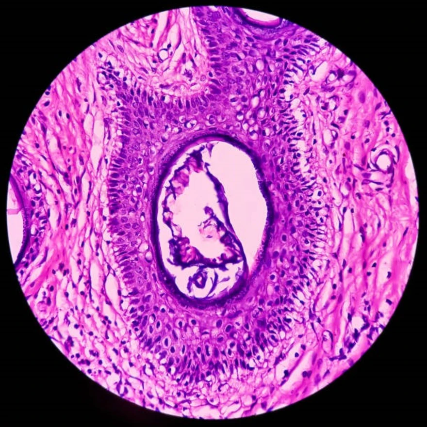 Teratoma: Symptoms, Causes, Treatment & Types