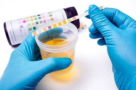 Urine Test: Normal Range, How it Works, Preparation, Tips and Results