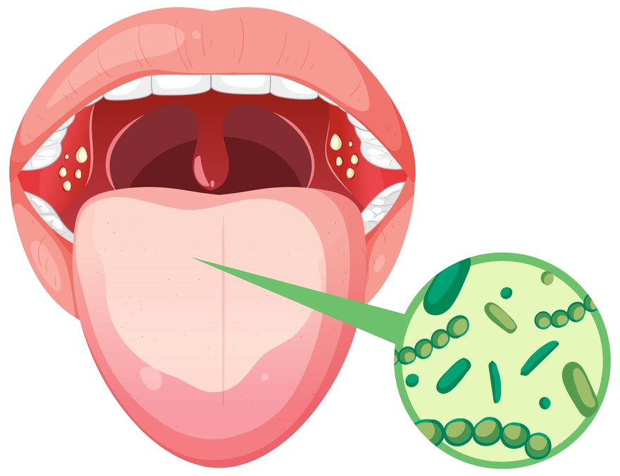 Tongue Cancer: Early Symptoms and Signs to Watch Out For