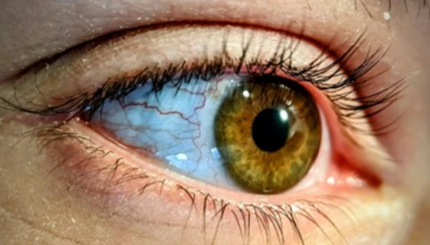 Trachoma: Causes, Symptoms, And Treatment