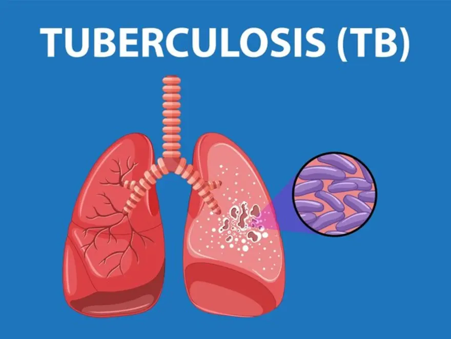 Tuberculosis Decoded: Understanding the Origins, Signs, and Remedies