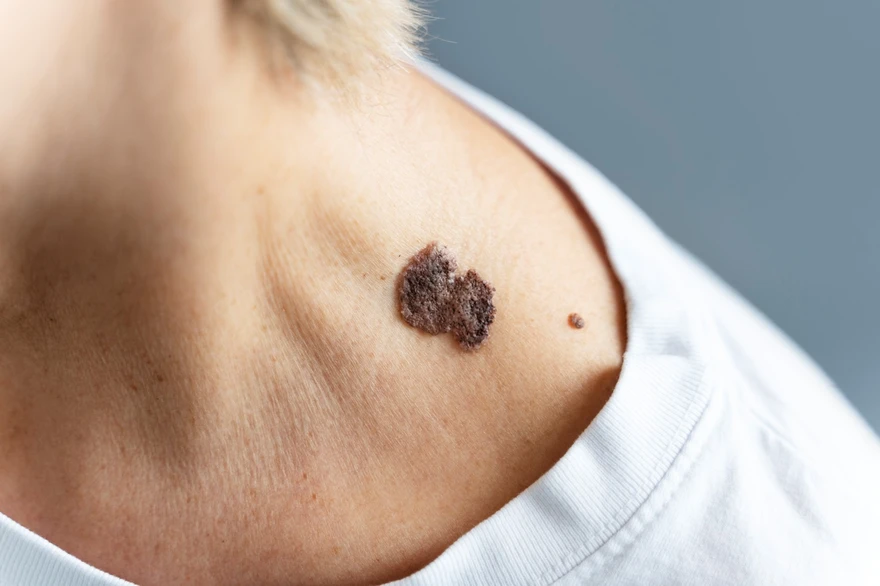 Tuberous Sclerosis: Causes, Symptoms & Treatment