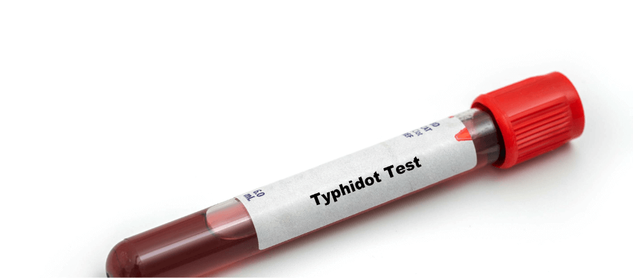 Typhidot Test: Procedure, Preparation, & Report