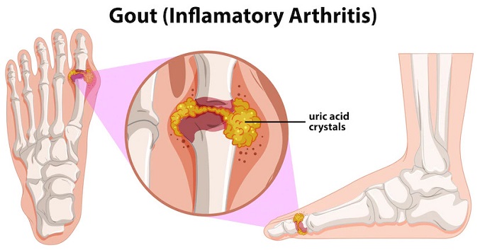 Uric Acid Test: Purpose, Procedure, Results, Normal Range and More