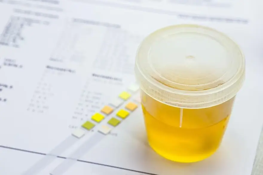 Urinalysis (Urine Routine Test): Results, Types, Purpose & Procedure