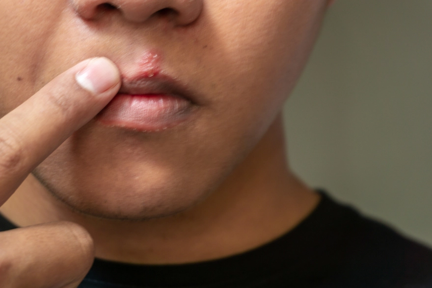 Cold Sore: Causes, Symptoms, and Effective Treatments