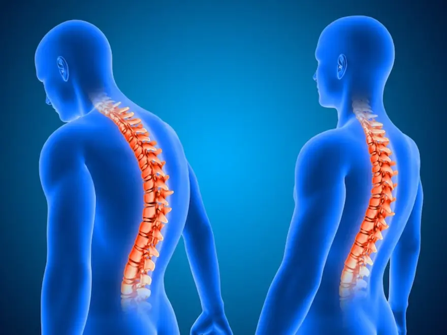 Understanding Kyphosis (Roundback): Symptoms, Causes, and Treatment