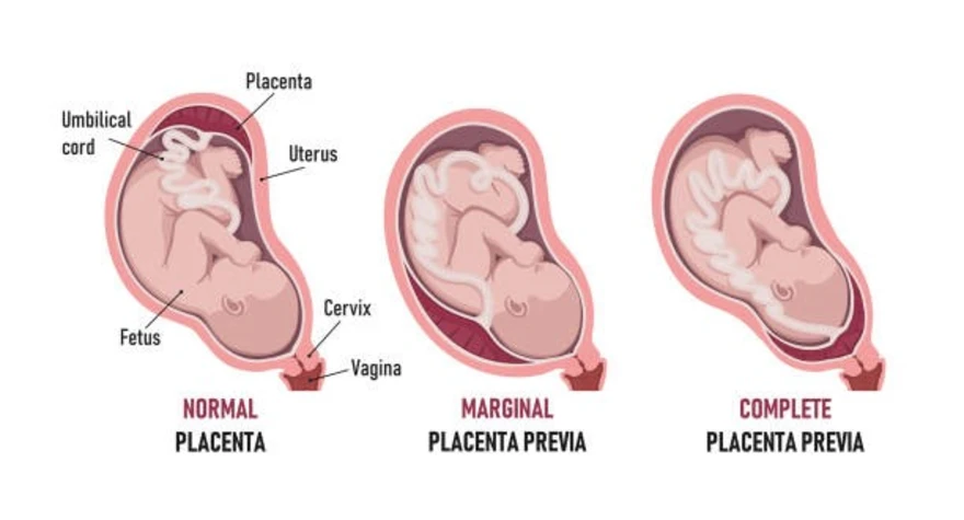 Exploring Placenta Previa: Types, Symptoms, Causes, and Treatment
