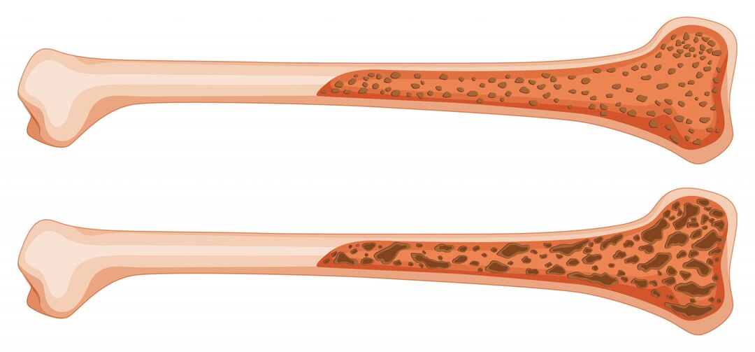 Metropolis Expert Speaks About Curing Cancer with Bone Marrow Transplant