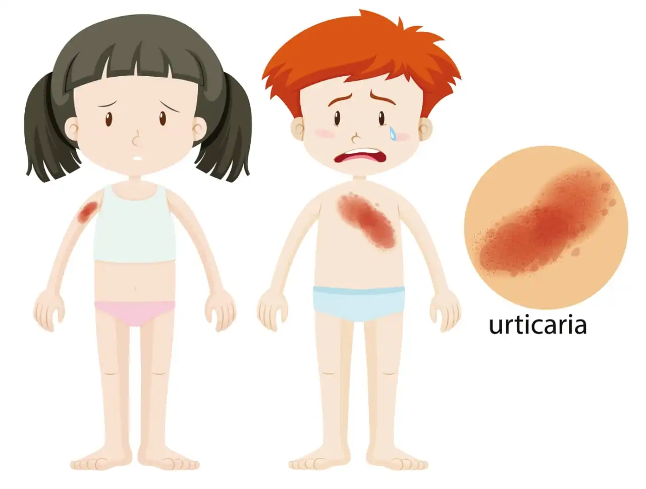 What are Hives: Causes, Symptoms, and Effective Treatment