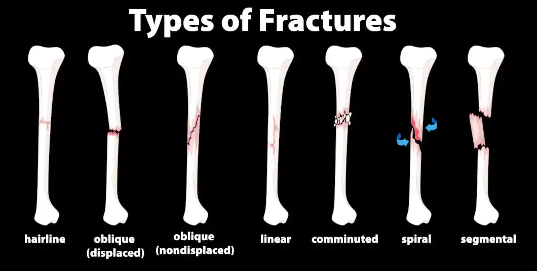 Bone Fractures: Types, Symptoms & Treatment